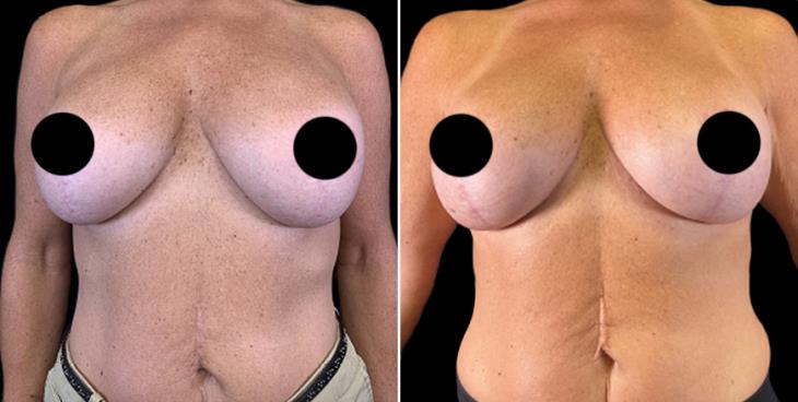 Breast Implant Replacement Case